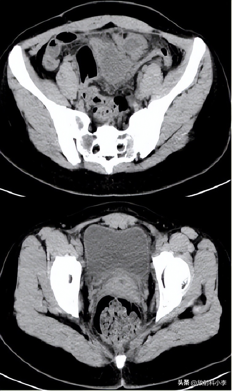 妇科急腹症的ct表现,妇科急腹症的诊断与治疗