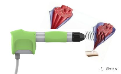 冲击波疗法在手指腱鞘炎中的应用