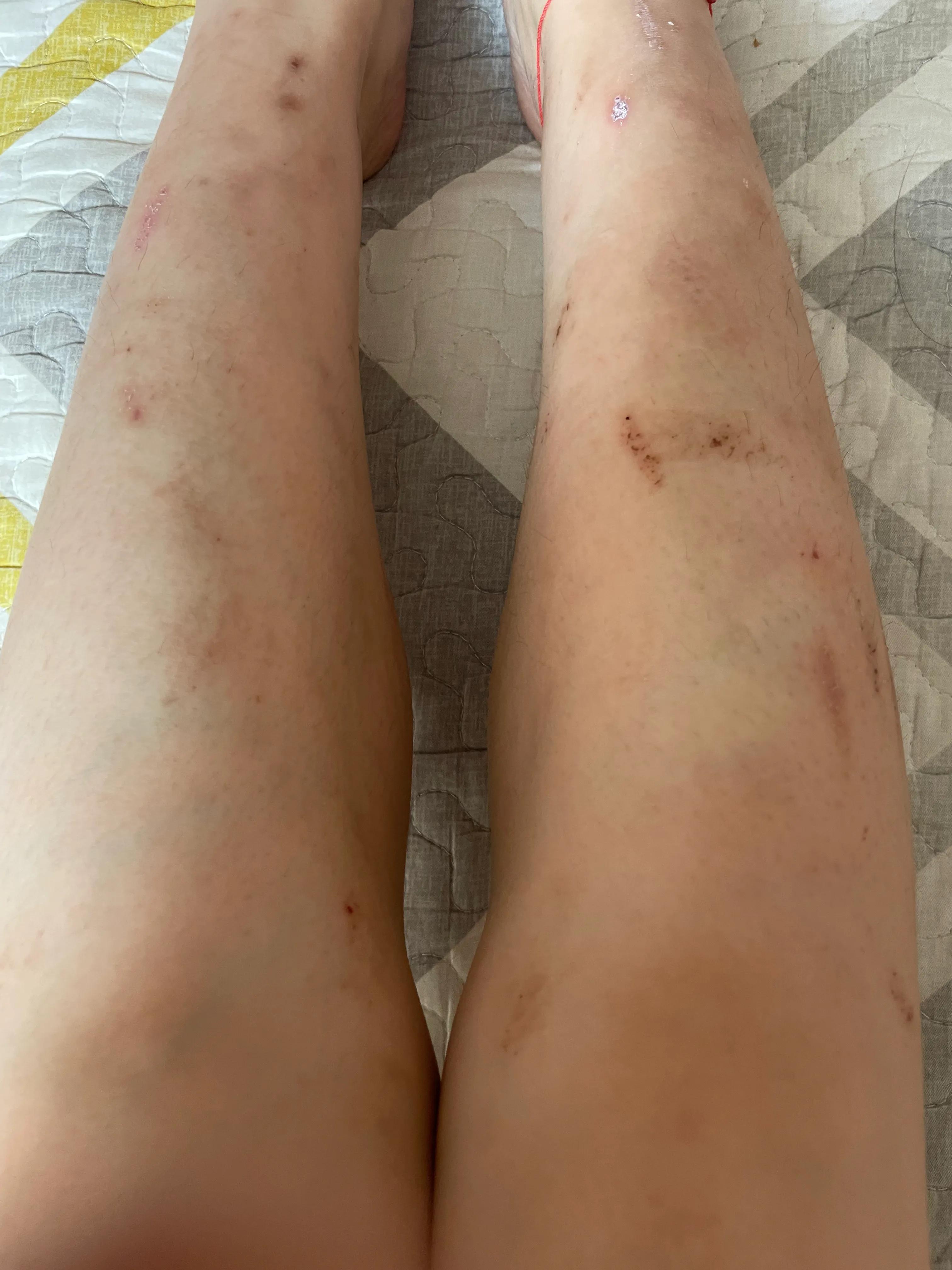 怎样去除腿上蚊子叮咬留下的疤痕,被蚊子叮咬留下的疤痕怎么消除