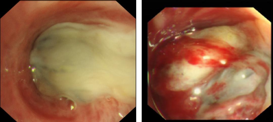 病死率和致死率,病死率20%