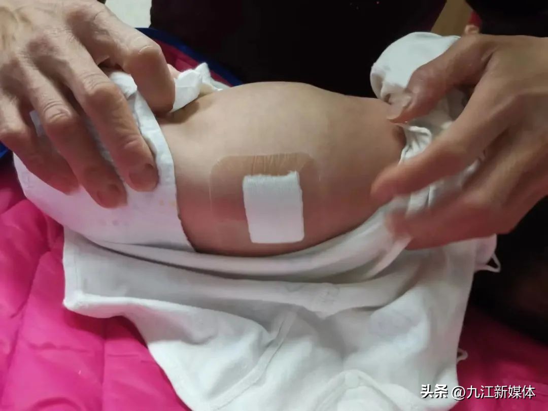 婴儿左肾重度积水怎么办,刚出生的婴儿肾积水22mm