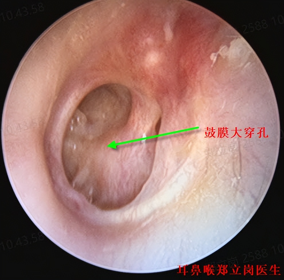 老人家有中耳炎，治疗还有不要嘛