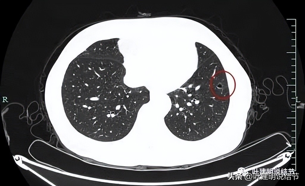 辽宁省肺结节手术哪家医院好,辽宁肺结节手术医院