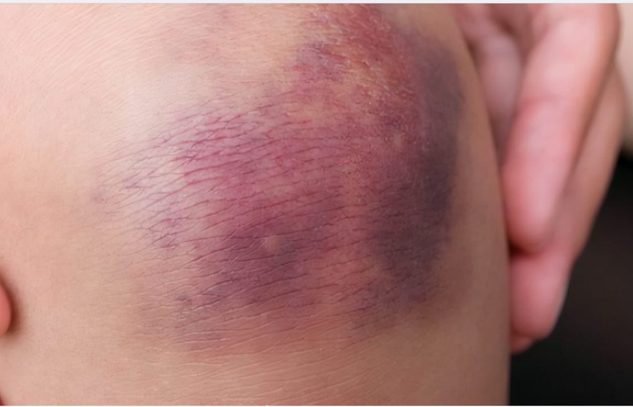 山西钴中毒事件,1992年的山西钴辐射事件