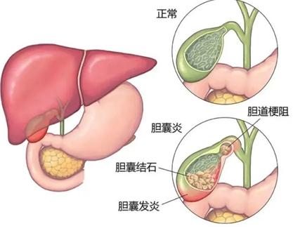 胆囊充满型结石无症状要怎么治疗,胆囊结石1.5厘米无症状需治疗