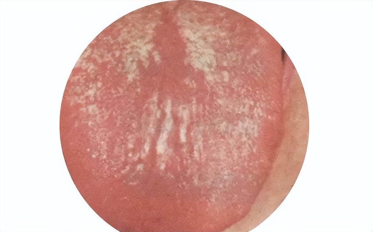 中医小儿舌苔图解,中医看小孩舌苔