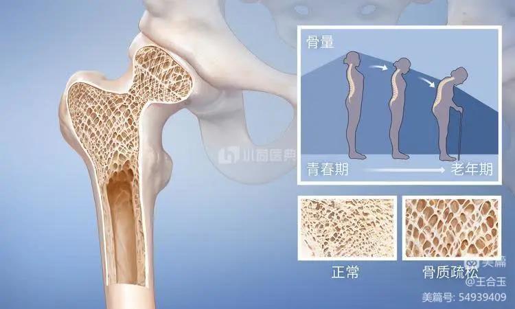 老年骨质疏松压缩性骨折怎么治疗,骨肽治疗老年骨质疏松症有效吗