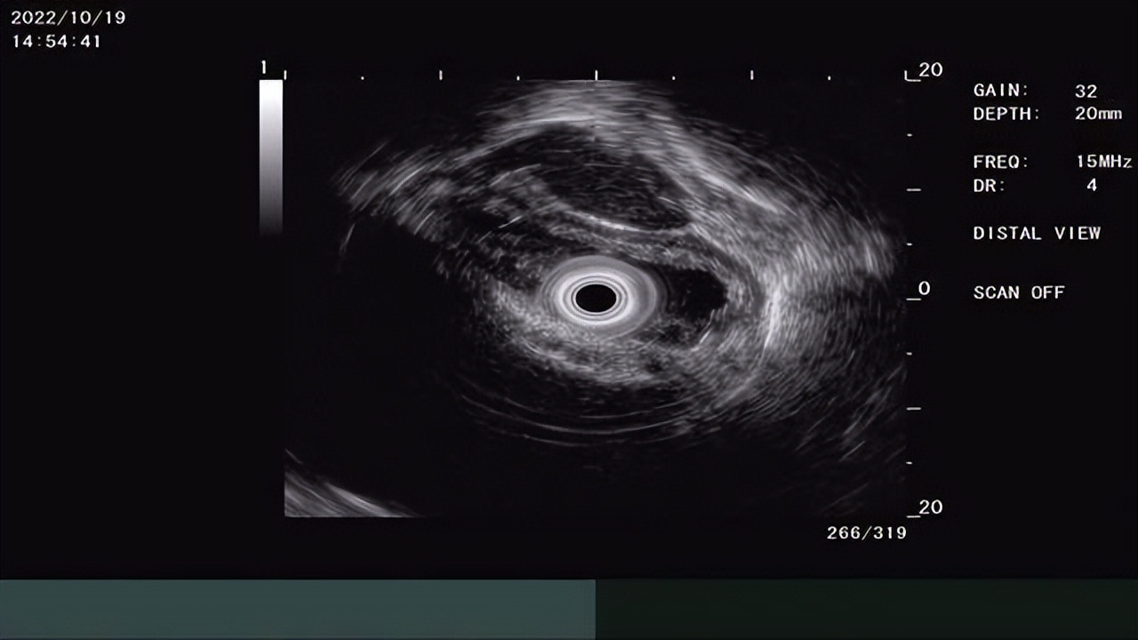 西安市红会医院：七旬老人患食管癌消化内科内镜黏膜下剥离术除烦恼