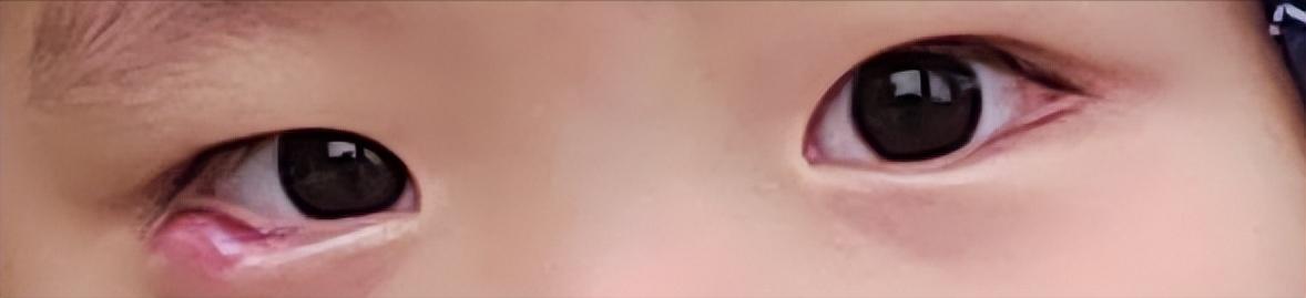 中医治疗霰粒肿15例,儿童霰粒肿中医消除办法