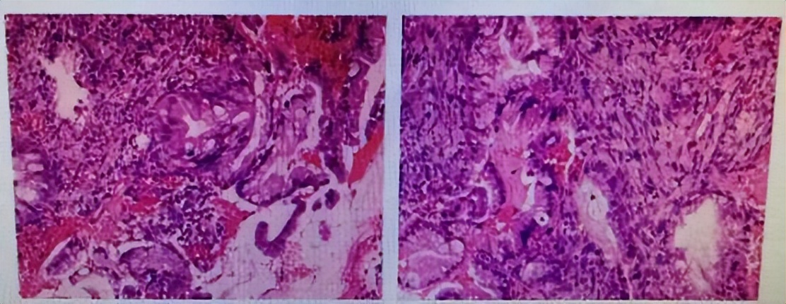 还有两个未成年孩子的母亲，确诊了晚期宫颈癌——我的诊治感悟