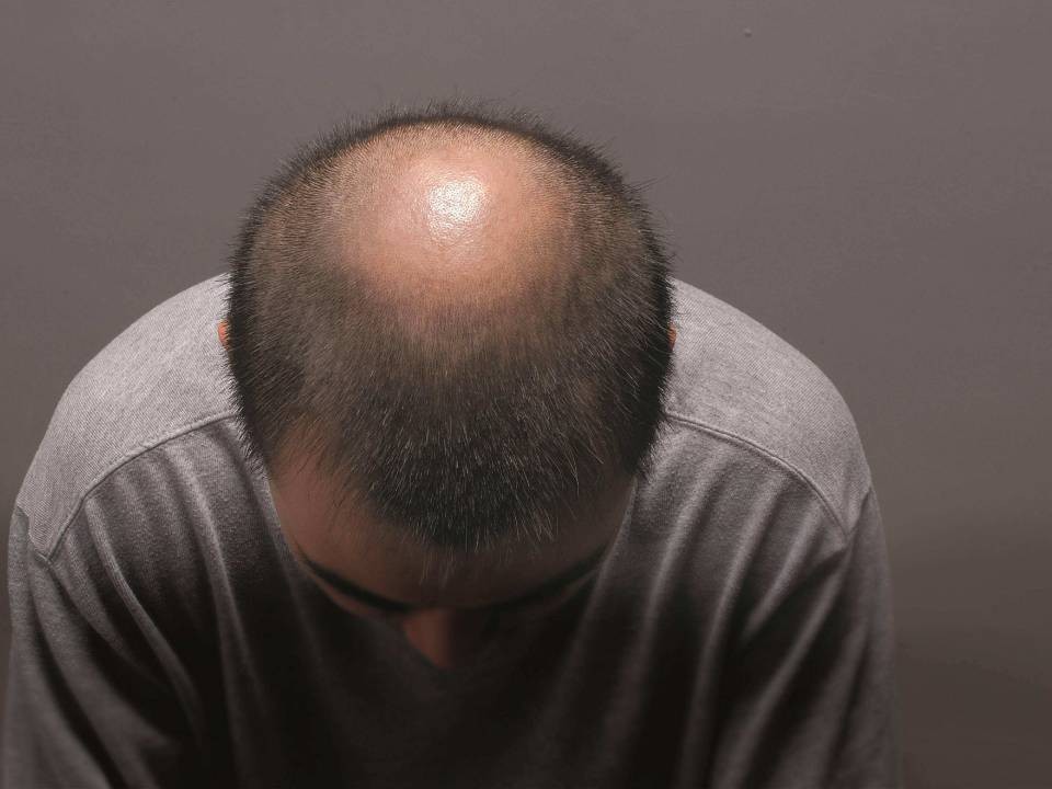 脱发为什么都是从头顶先秃,脱发为什么先从头顶脱