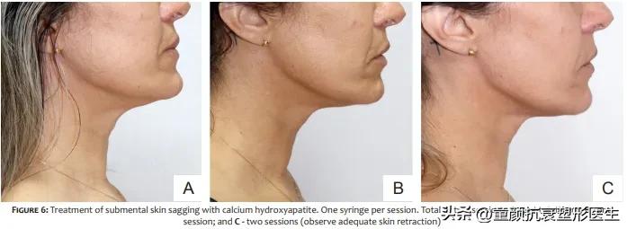 抽脂针瘦脸,抽脂溶脂针