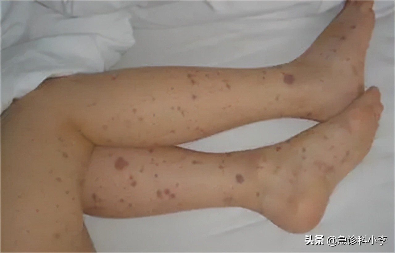 孩子身上小红点不痛不痒是什么病,身上起小红点不痛不痒按压会消失