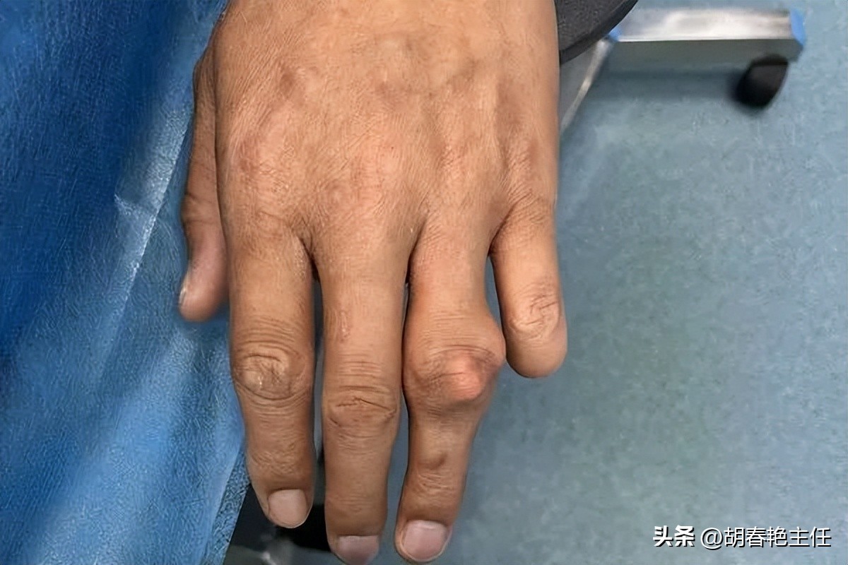 痛风石可以吃药溶解吗,怎样溶解痛风石