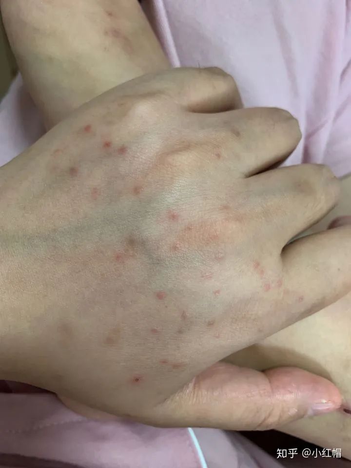 最可怕的癌症复发方式,癌症复发恐惧