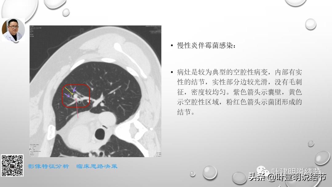 在《一脉阳光》呼吸影像诊断专题培训班上的讲课PPT（第一部分）