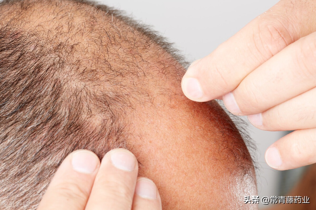 米诺地尔到底能不能治疗脱发,米诺地尔治疗哪种脱发最有效
