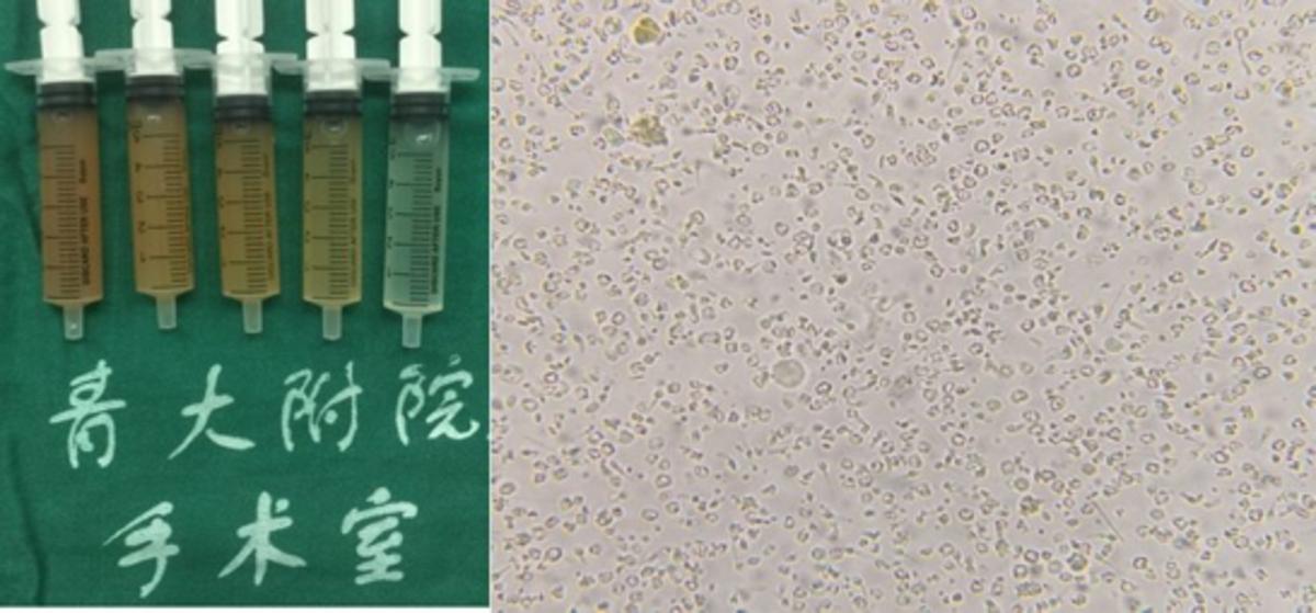 男性梗阻性无精症可以人工授精吗,男科梗阻性无精症