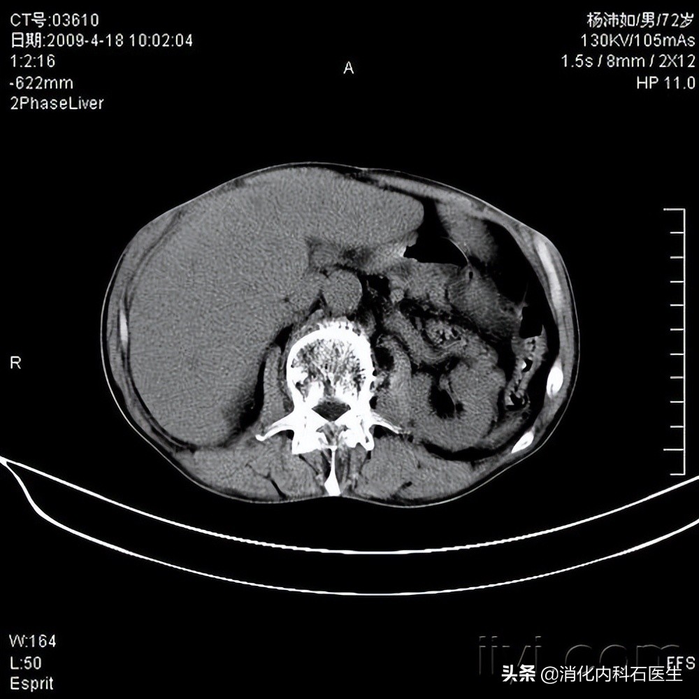 高中女孩子腹痛的原因,高中女生腹痛就医