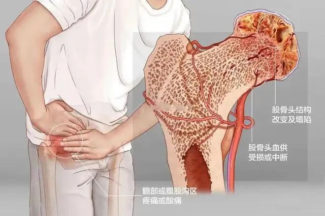 什么样的外伤引起股骨头坏死,一次突如其来的骨折