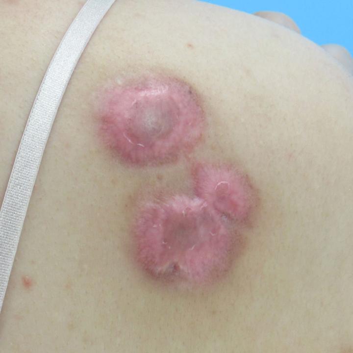 增生性疤痕与疤痕疙瘩的区别,凹陷性疤痕和疙瘩疤痕哪个好治疗