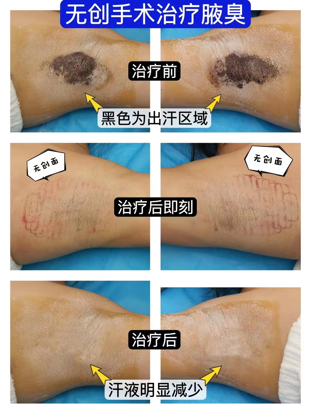 治疗狐臭微波用多少钱,清新微波治狐臭价格