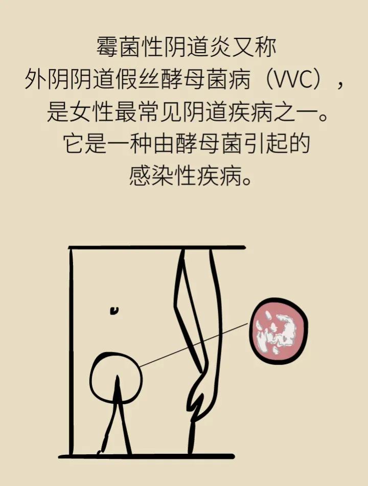 大蒜水冲洗外阴,霉菌性外阴炎中药熏洗方法