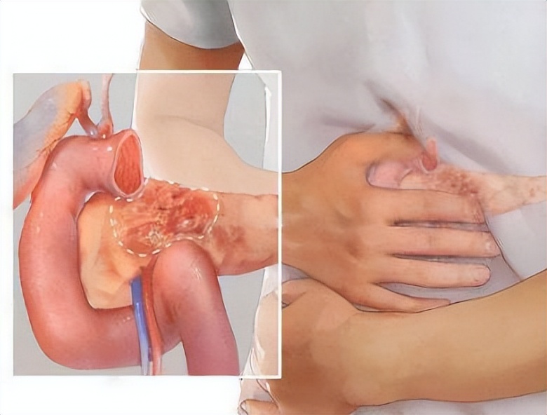 医生提醒：酒后若出现这5种症状，可能是“胰腺炎”，别忽视