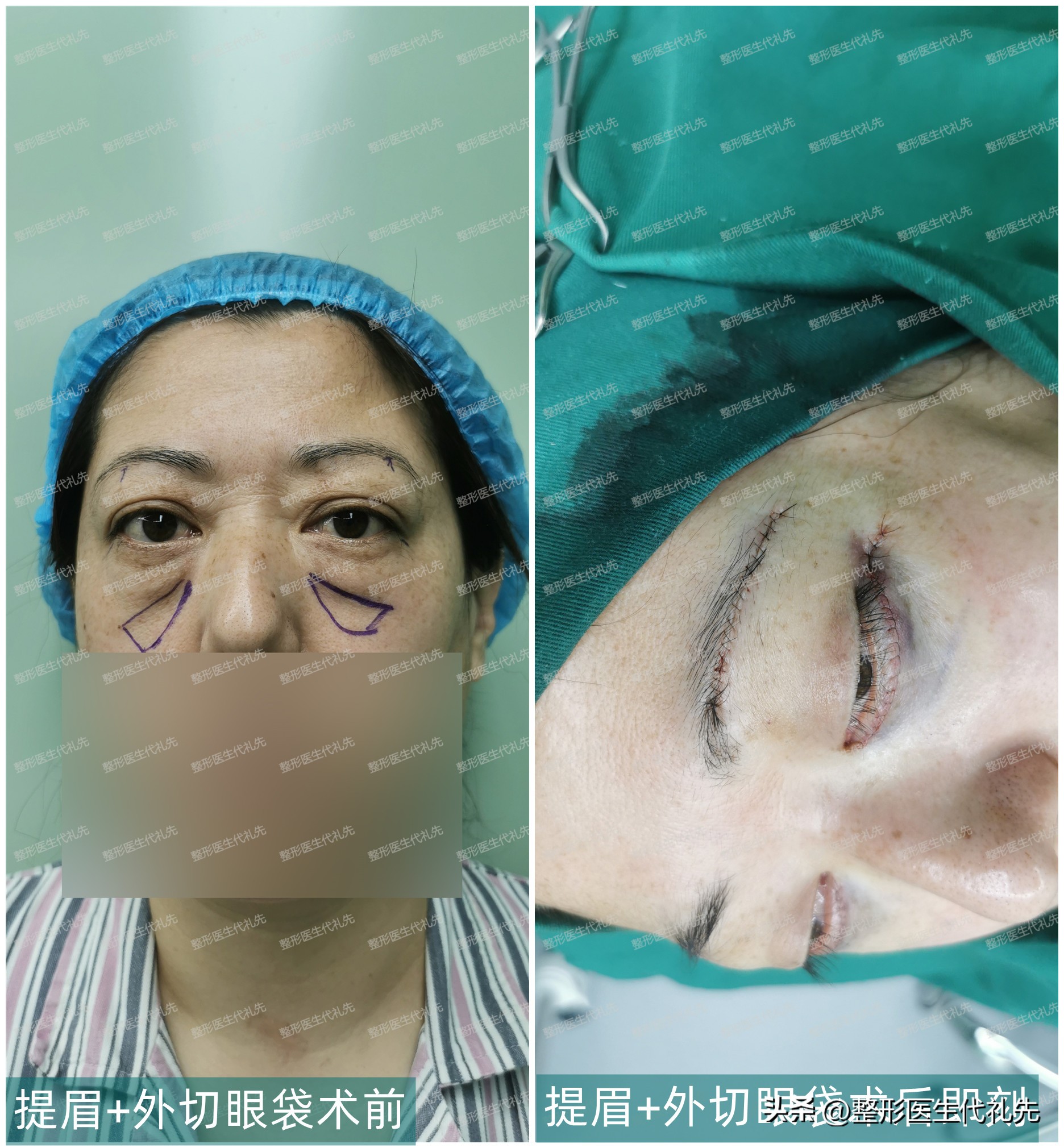 眼袋形成的真正原因,眼袋是怎么形成的去除眼袋的方法