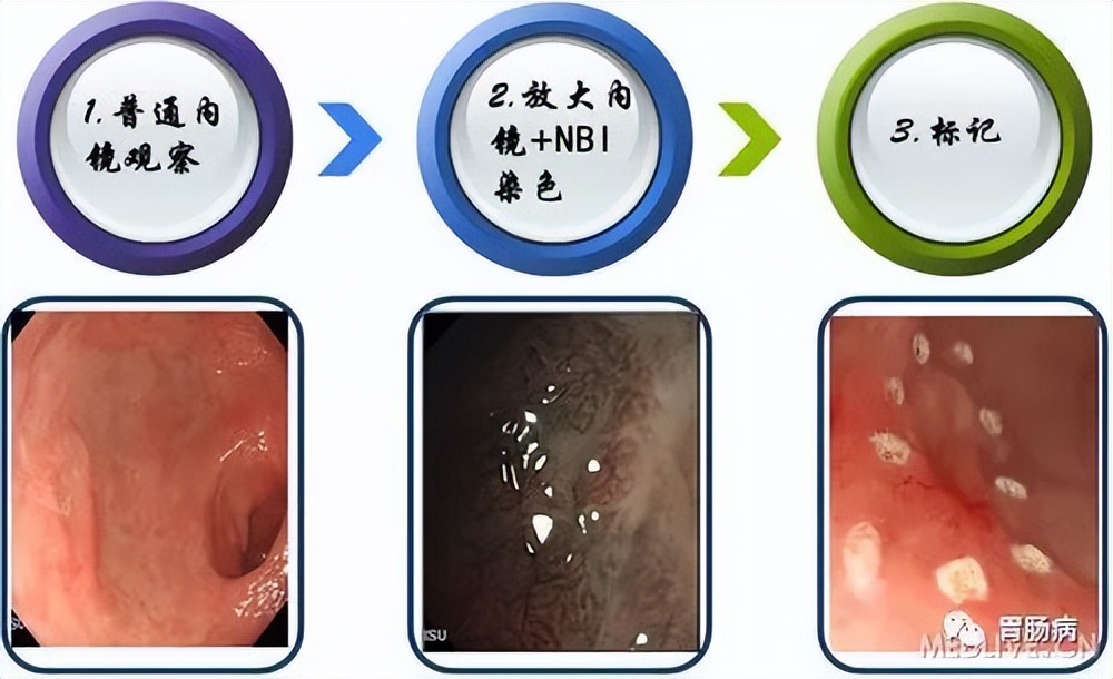esd内镜下粘膜剥离几天可愈合,内镜下粘膜剥离术属于esd还是emr