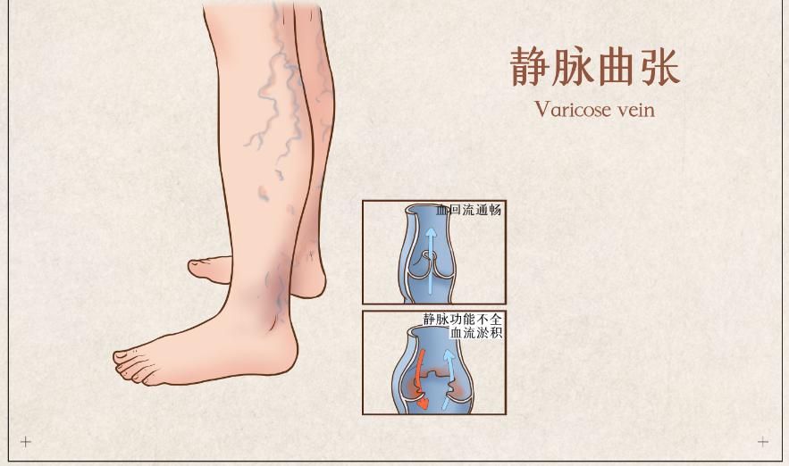 静脉曲张蚯蚓腿怎么回事,静脉曲张多久会形成蚯蚓腿