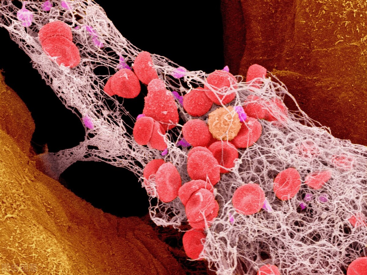 血栓与斑块有什么区别,血栓和斑块儿有什么区别