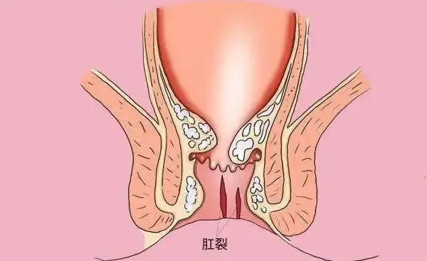 肛裂痔疮引起的便血什么样,痔疮便血跟肛裂便血的区别
