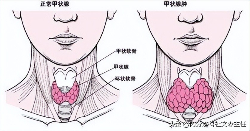 甲状腺中度肿大伴甲亢没办法治好,单纯的甲状腺肿大能治愈吗如何治
