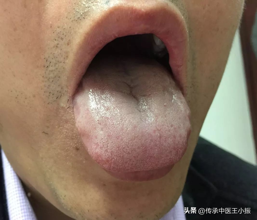齿痕舌和裂纹舌中医辨证,舌胖大有齿痕中医辨证