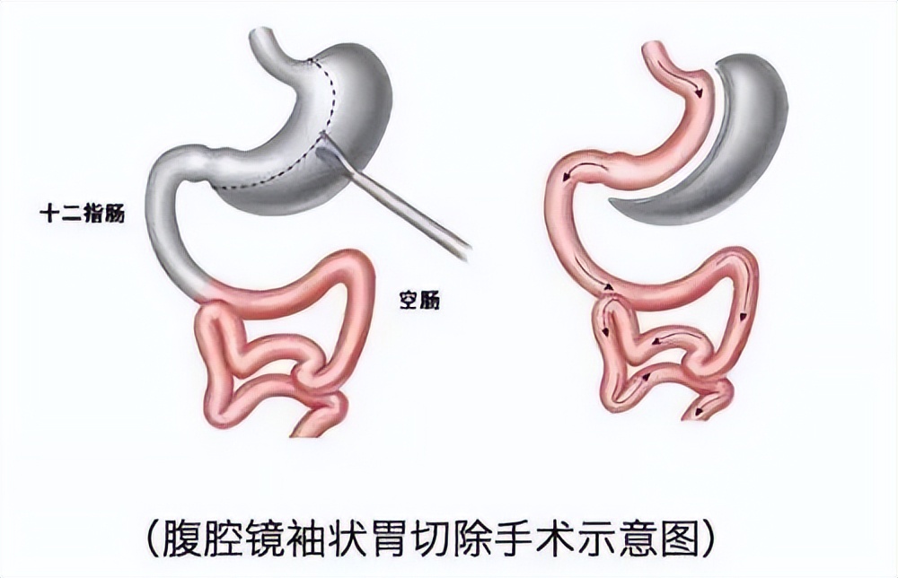 全球有30%因肥胖而死亡,全球每年280万人因肥胖死亡