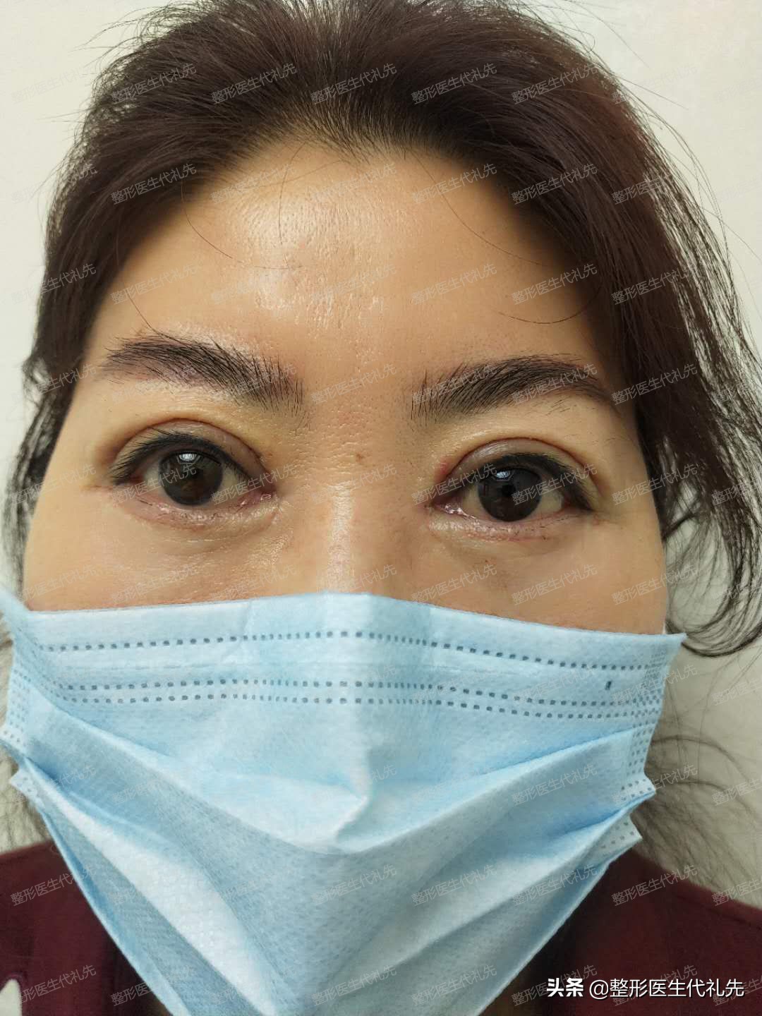 全切双眼皮5个月修复调整全过程,全切双眼皮个人恢复过程经历真实