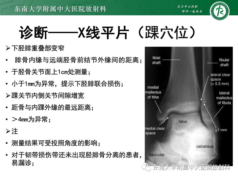 左腓骨下段骨折伴下胫腓联合分离,好文分享深度揭秘
