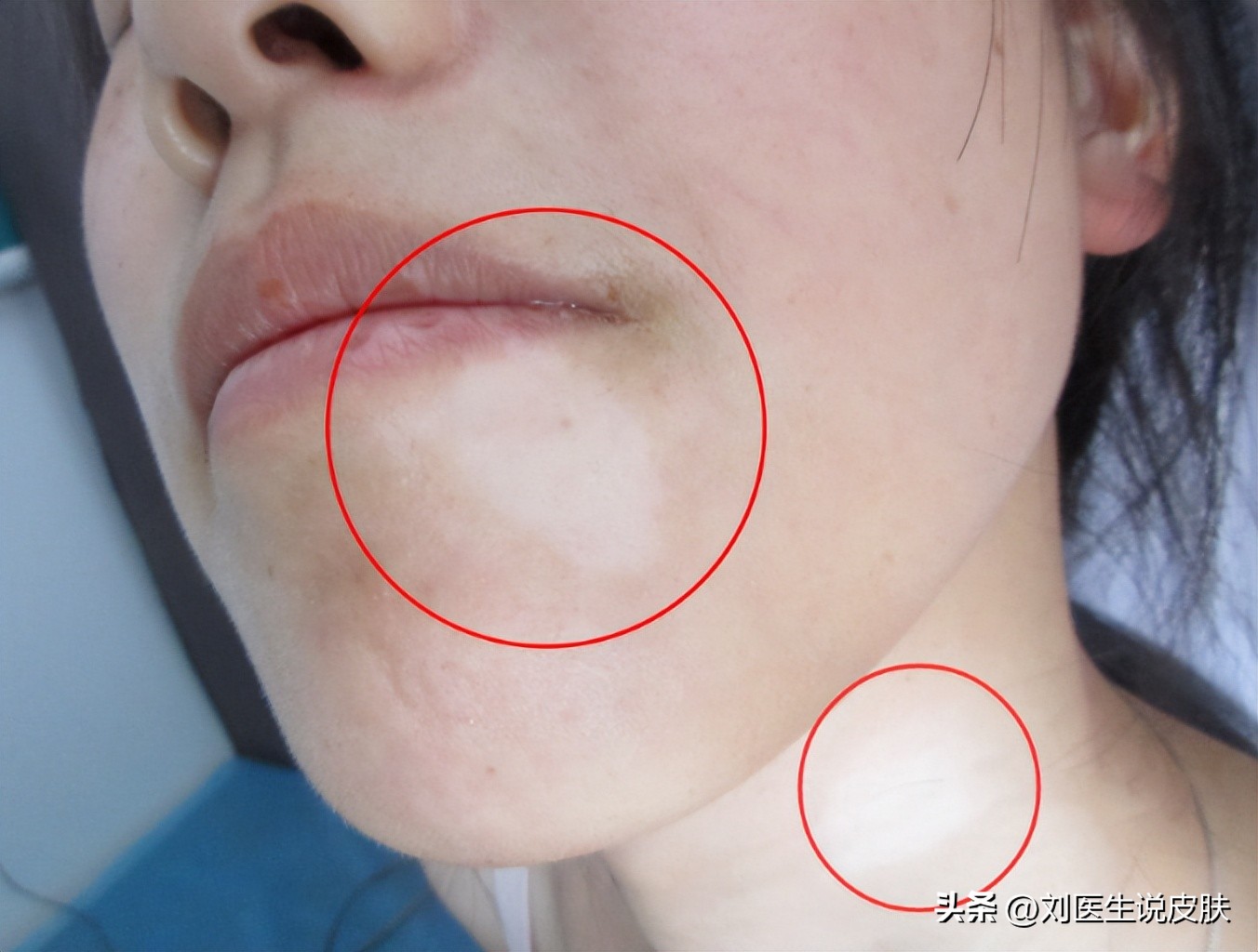 白癜风是什么引起的白癜风怎么治,得了白癜风怎么治白癜风效果好