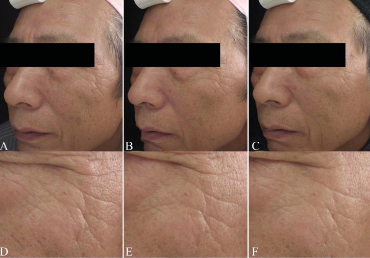 黄金微针能永久收毛孔吗,黄金微针是不是越肿效果越好