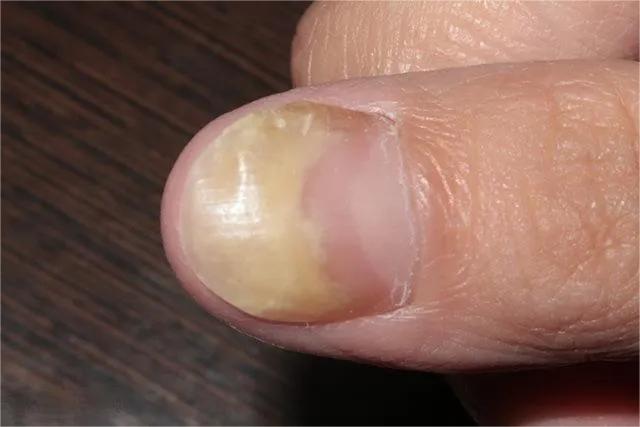 甲癣不严重怎么治疗,甲易生治疗灰指甲吗