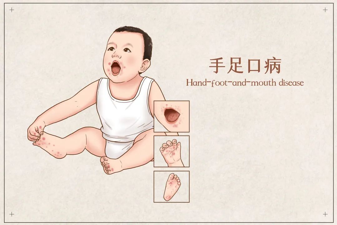 手足口病护理科普动画片,手足口病患儿的护理措施