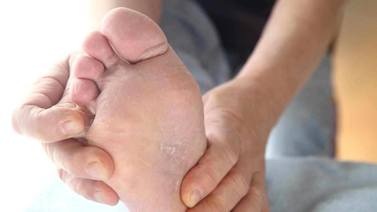 脚底痒有水泡是脚气还是湿疹,湿疹和脚气哪个会痒的比较厉害