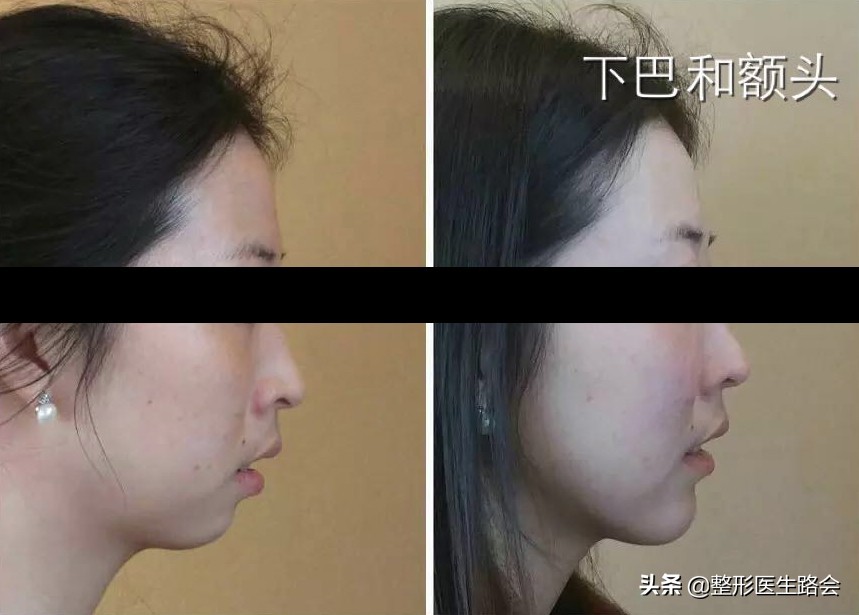 填充额头为什么额头有坑,填充额头过度饱满怎么消除