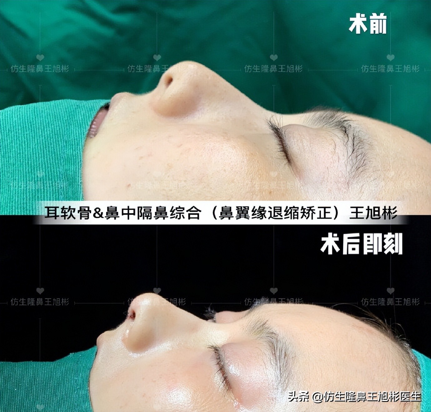 王旭彬：朝天鼻、露鼻孔，模特菲菲短鼻矫正手术后1.5个月