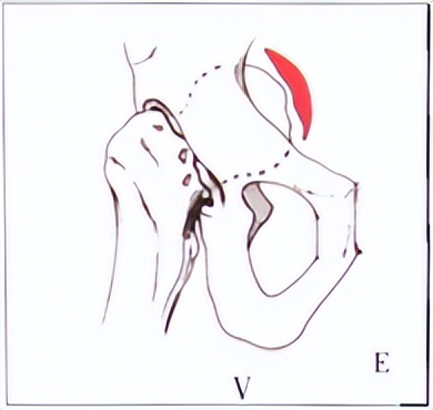 老人股骨头骨折手术,股骨头骨折最佳手术方法