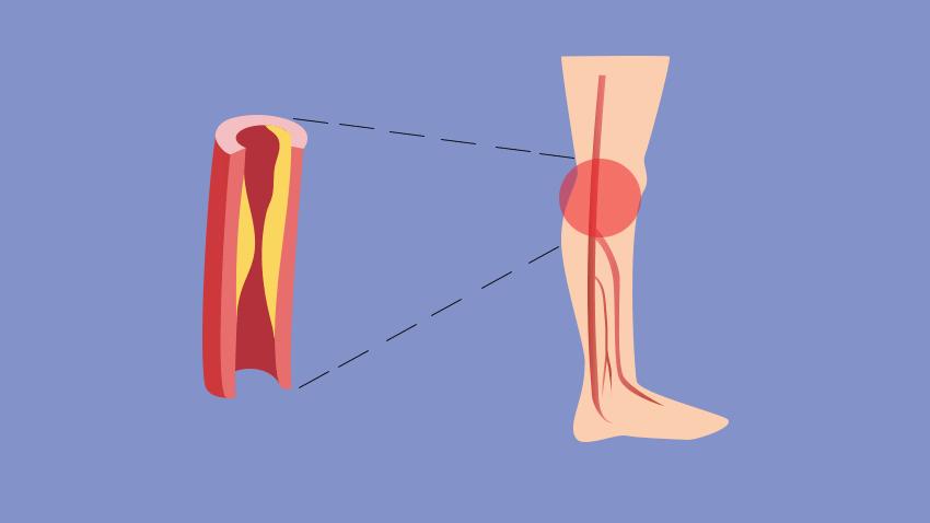 脚部信号透露健康问题,脚部出现这6种症状