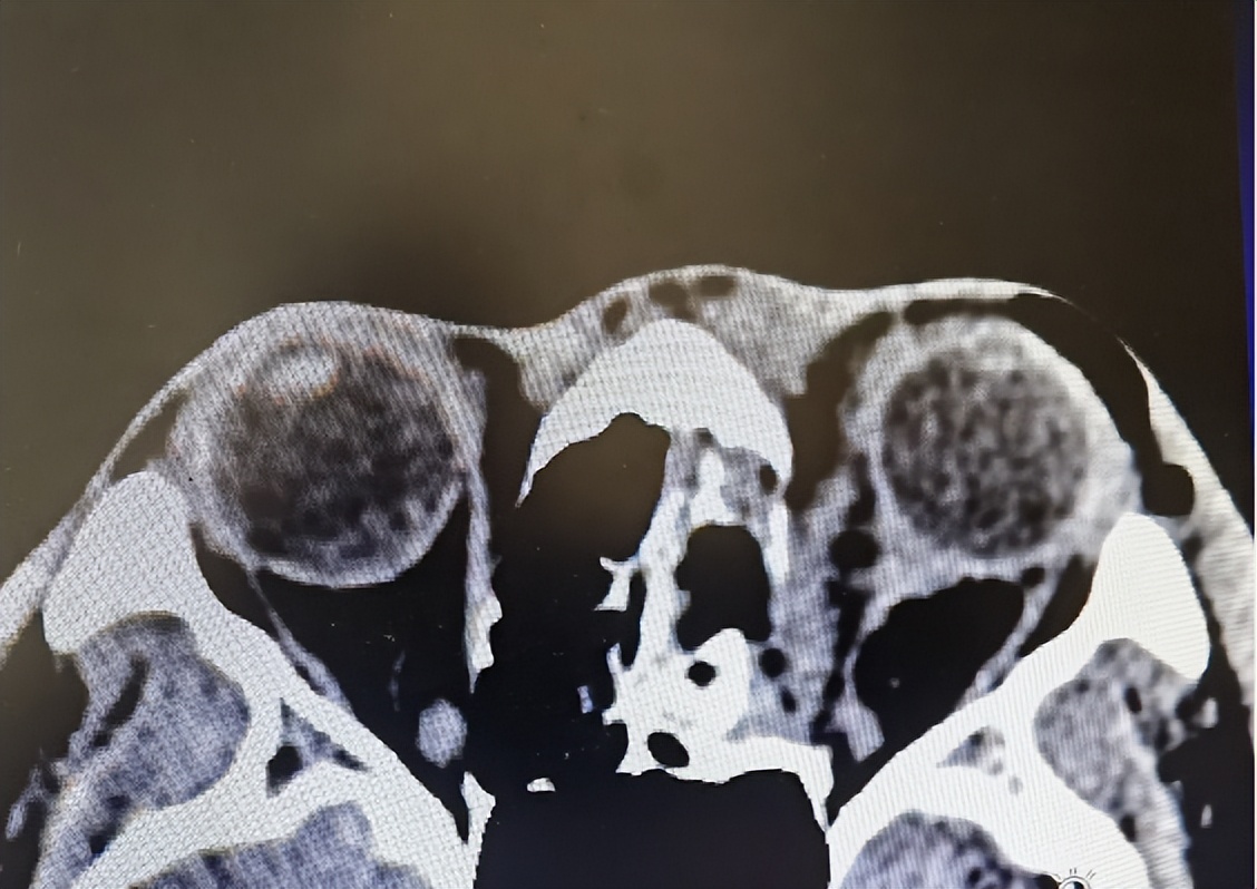 男子被砸脸眼球陷进鼻腔,男子鼻子被手机砸后屏幕却现凹坑