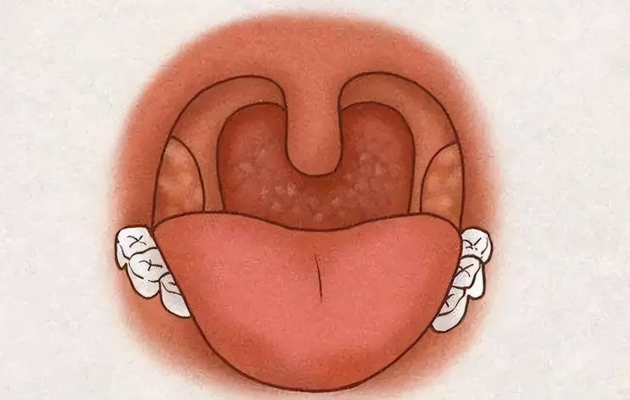 双黄连口服液佐治疱疹性咽峡炎的临床观察