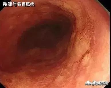 嗓子干痒、有异物感...当成咽炎，差点要命